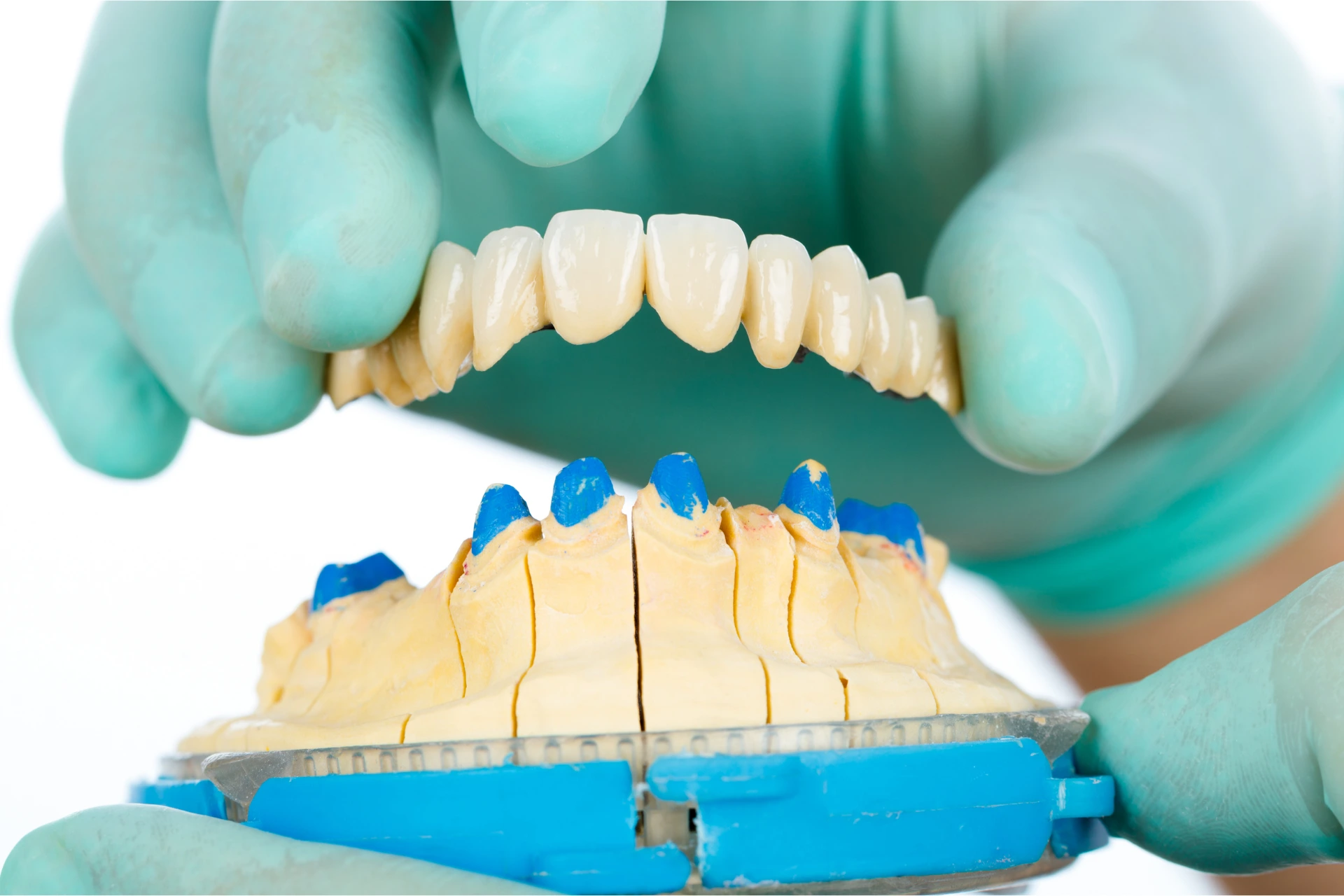 Types of Dental Bridges A Comprehensive Guide to Restoring Your Smile